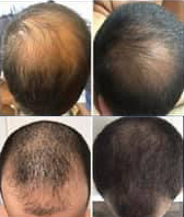 Male before and after photos of Hair Restoration