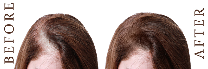Woman Before And After Hair Loss Treatment On White Background